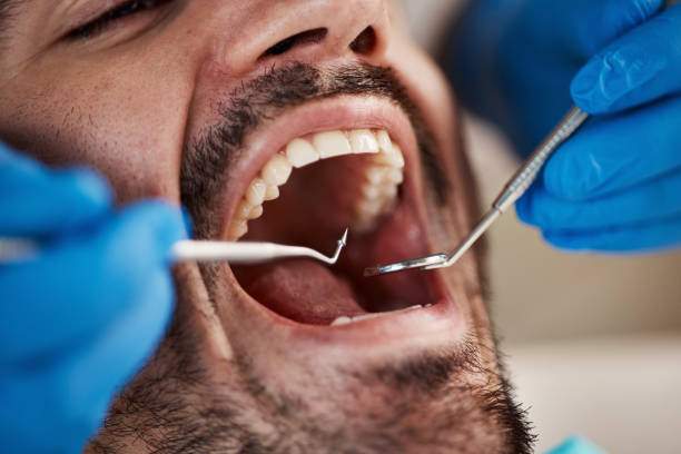 Dental Inlays and Onlays in Hanover, PA